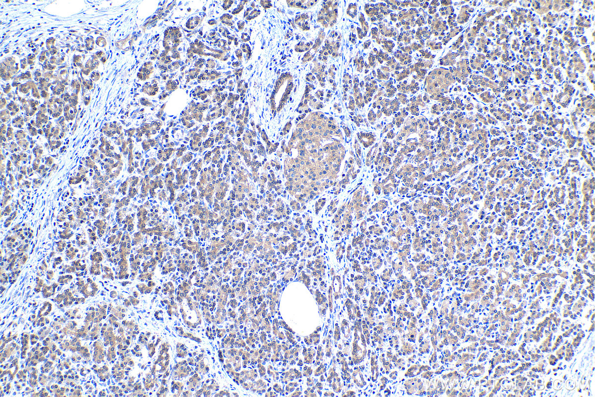 Immunohistochemistry (IHC) staining of human pancreas cancer tissue using MYCBP Polyclonal antibody (12022-1-AP)