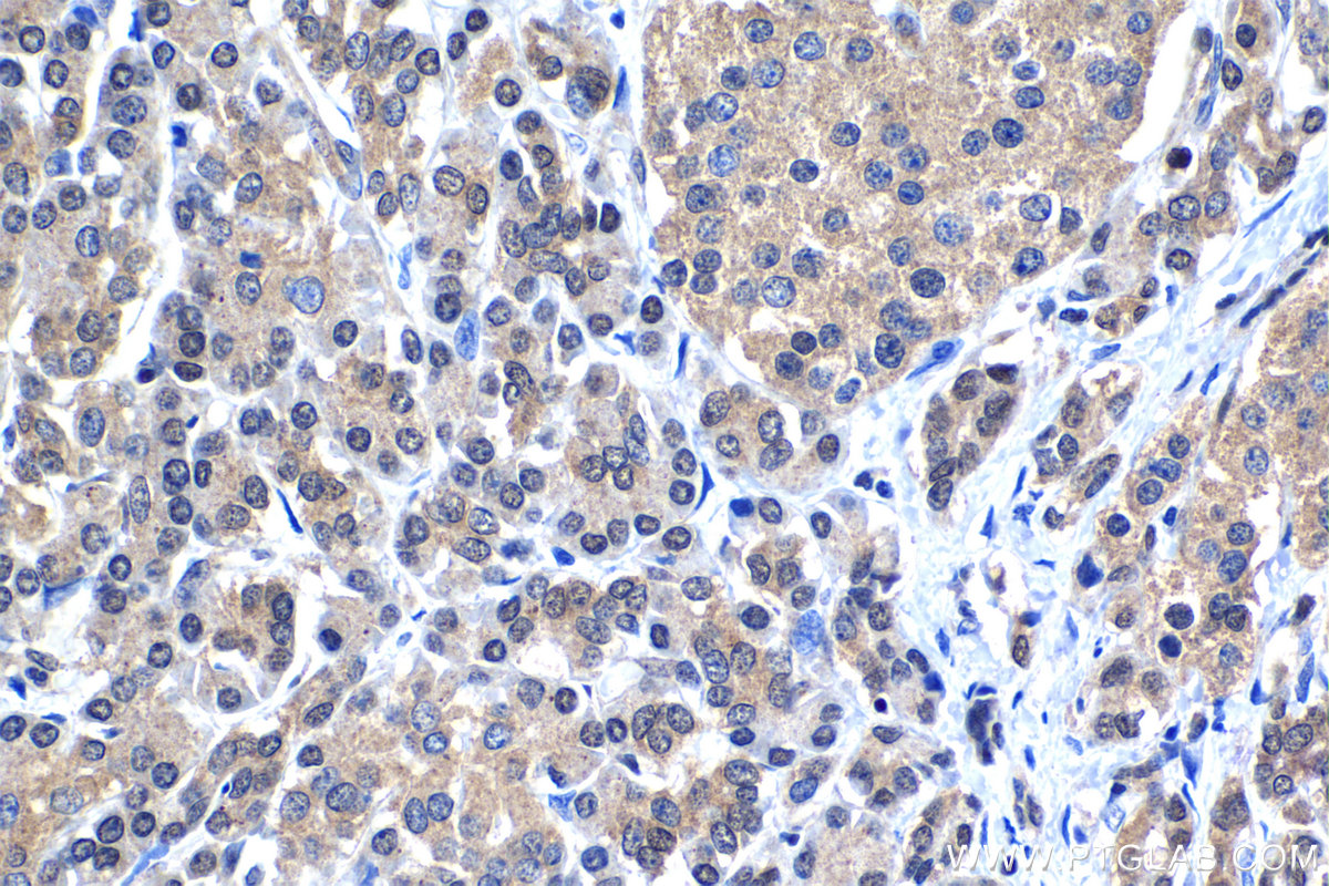 Immunohistochemistry (IHC) staining of human pancreas cancer tissue using MYCBP Polyclonal antibody (12022-1-AP)