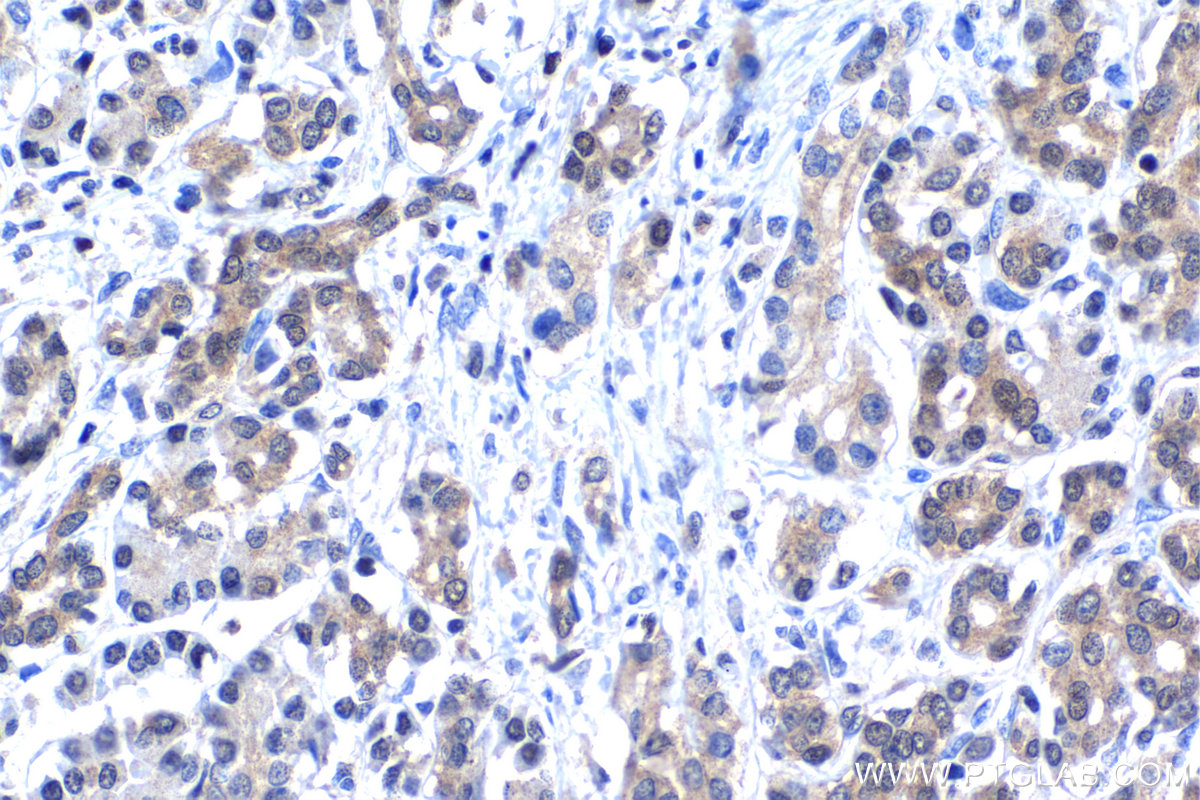 Immunohistochemistry (IHC) staining of human pancreas cancer tissue using MYCBP Polyclonal antibody (12022-1-AP)