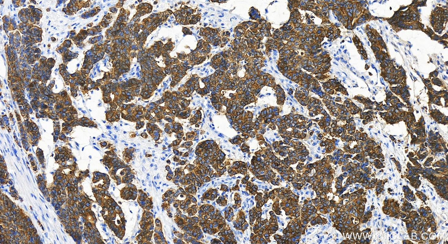 Immunohistochemistry (IHC) staining of human stomach cancer tissue using MYH14 Polyclonal antibody (20716-1-AP)