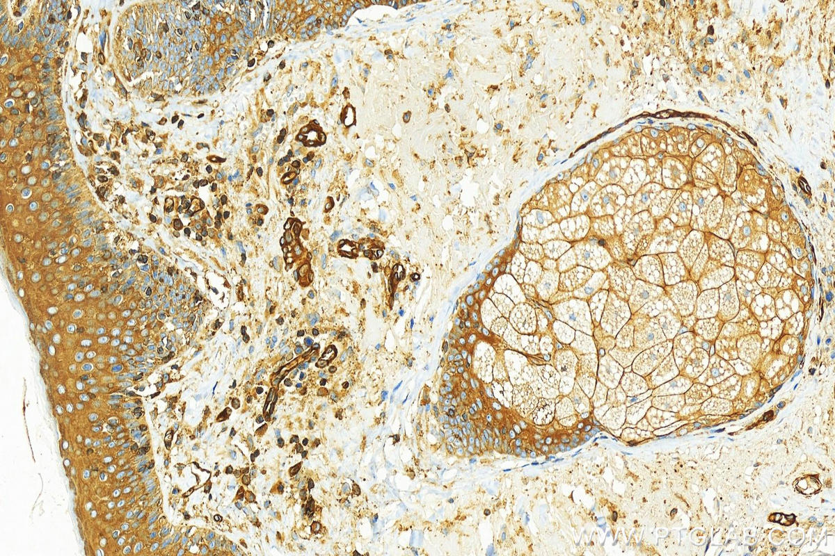 Immunohistochemistry (IHC) staining of human skin cancer tissue using MYH9 Monoclonal antibody (60233-1-Ig)