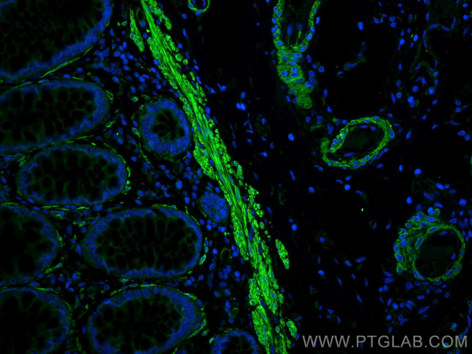 Immunofluorescence (IF) / fluorescent staining of human rectal cancer tissue using MYLK Polyclonal antibody (21642-1-AP)