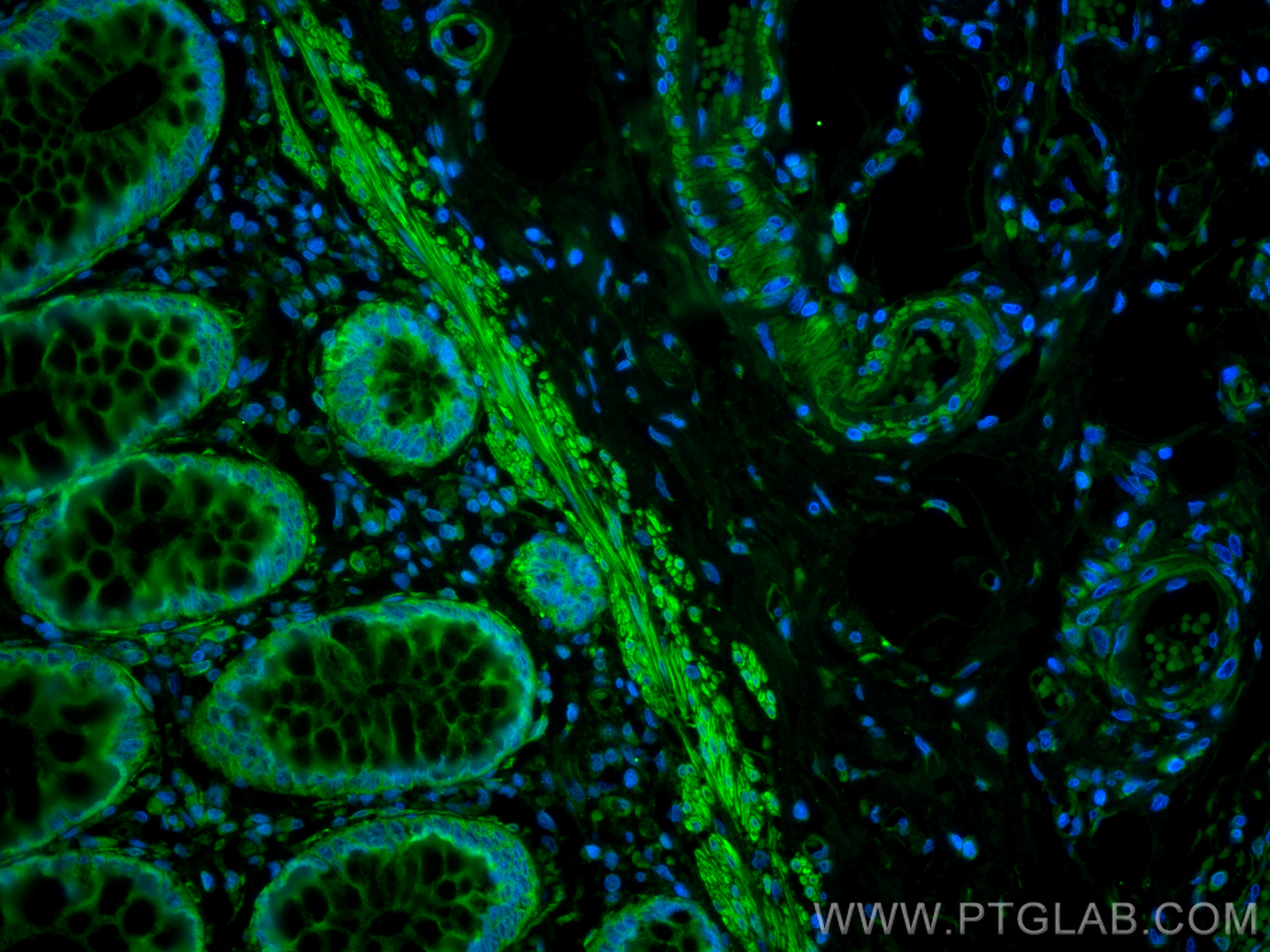 Immunofluorescence (IF) / fluorescent staining of human rectal cancer tissue using CoraLite® Plus 488-conjugated MYLK Polyclonal anti (CL488-21642)