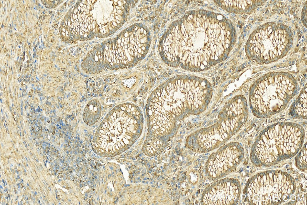 Immunohistochemistry (IHC) staining of human colon cancer tissue using MYO1A Polyclonal antibody (17499-1-AP)