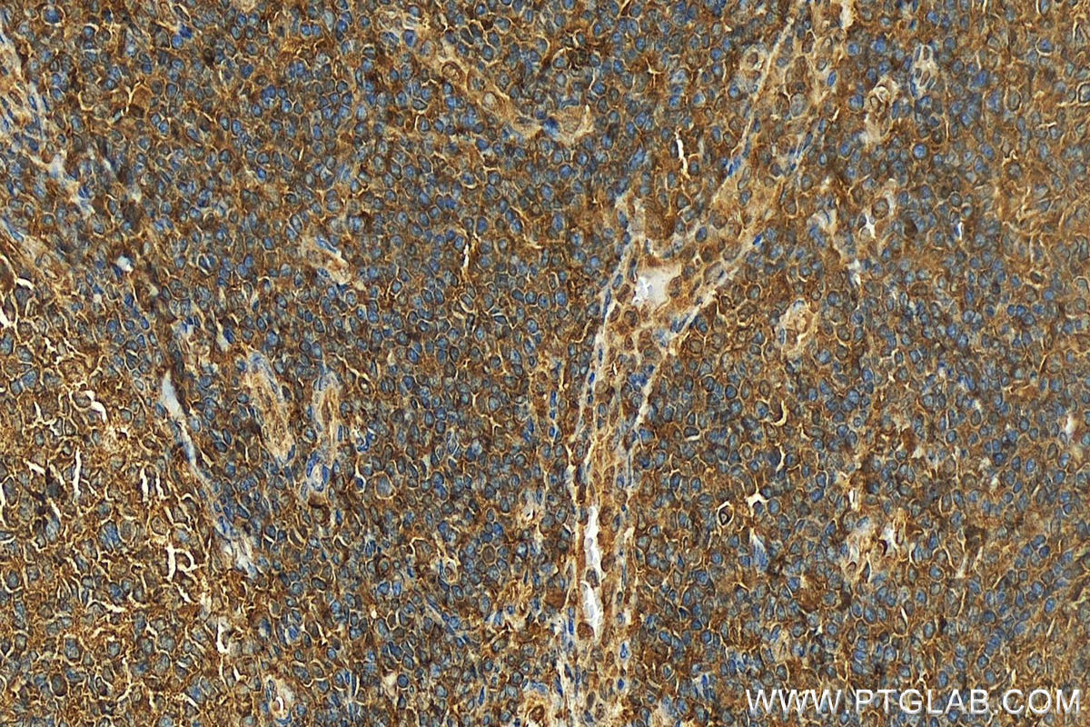 Immunohistochemistry (IHC) staining of human tonsillitis tissue using MYO9B Polyclonal antibody (12432-1-AP)