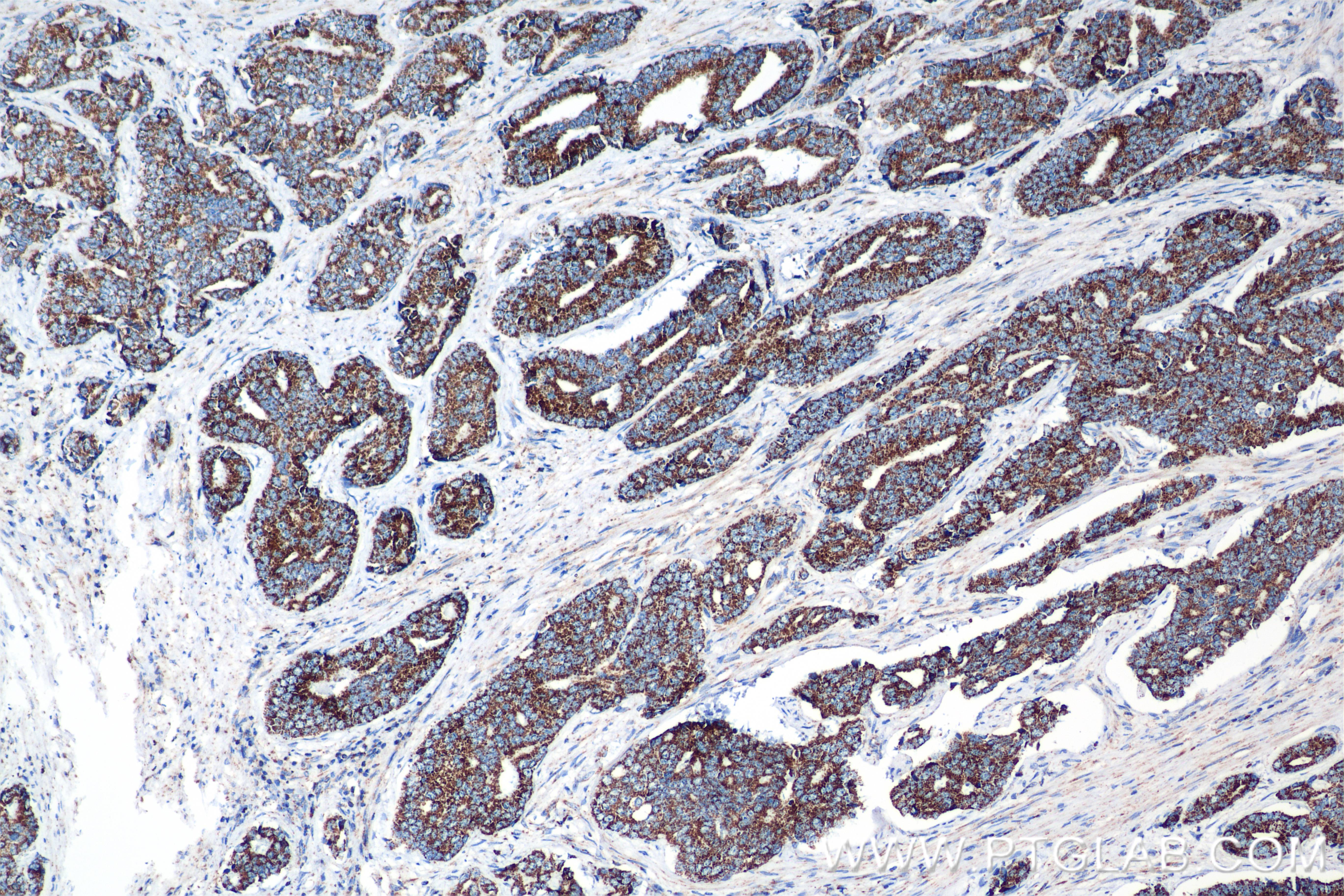 Immunohistochemistry (IHC) staining of human prostate cancer tissue using Methylmalonyl Coenzyme A mutase/MUT Recombinant an (84879-5-RR)