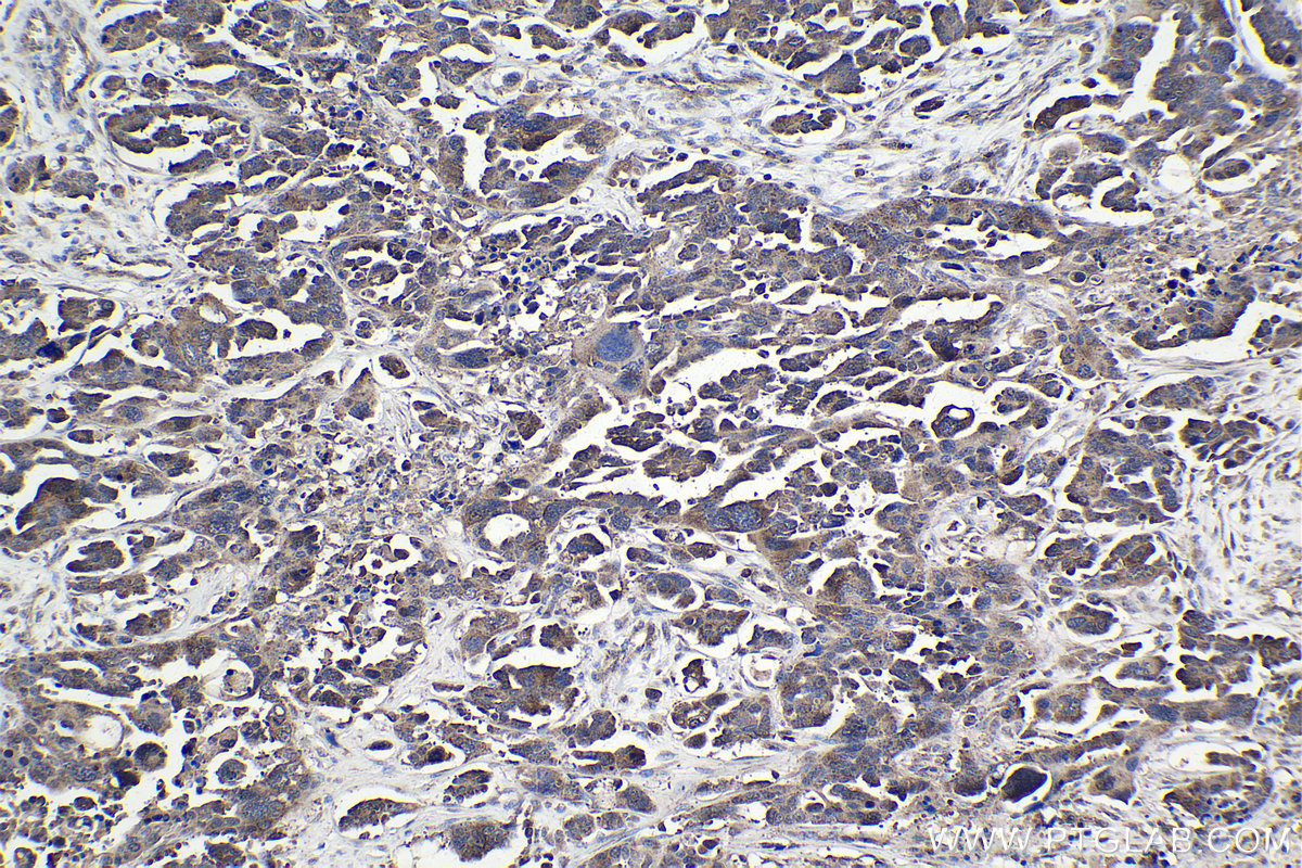 Immunohistochemistry (IHC) staining of human colon cancer tissue using MSI2 Polyclonal antibody (10770-1-AP)