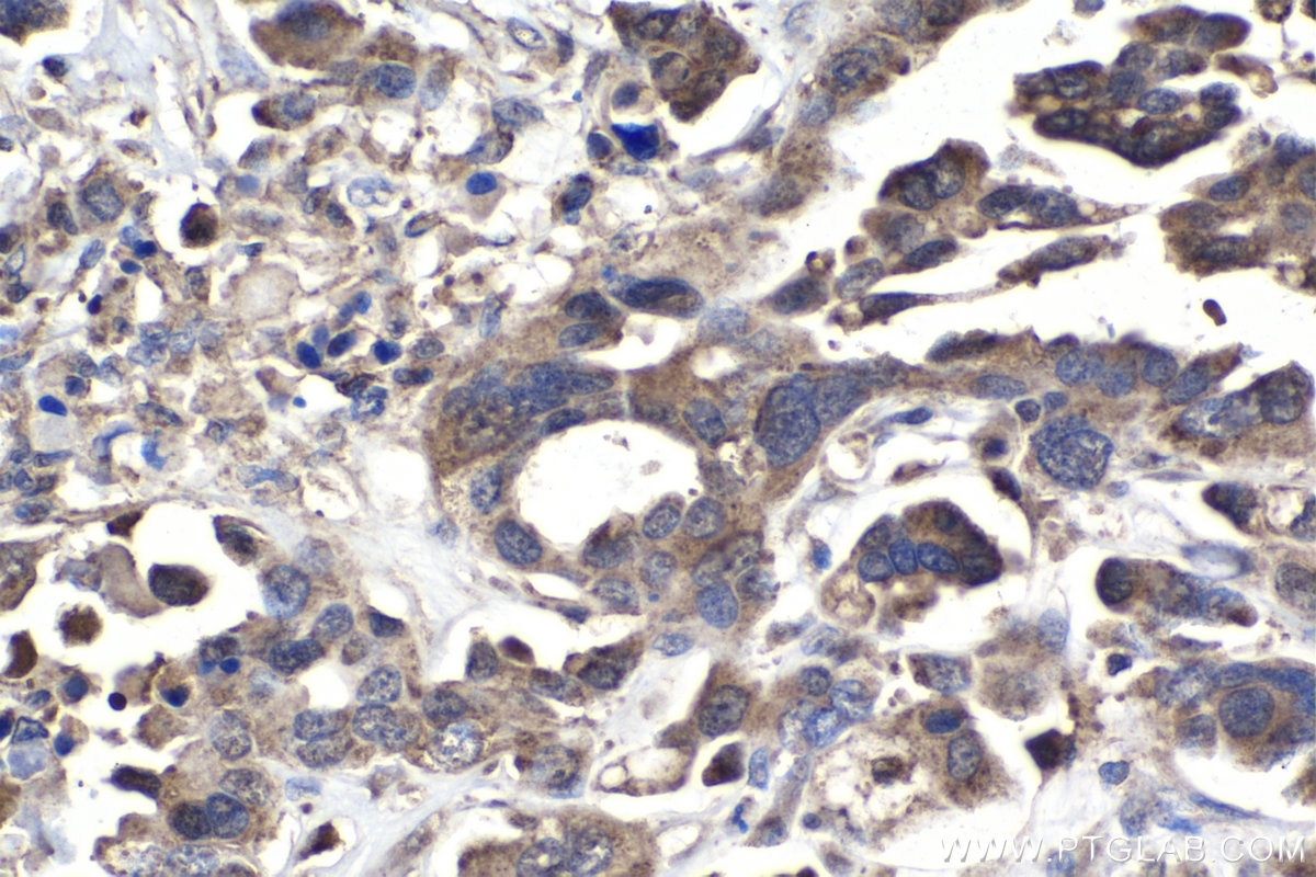 Immunohistochemistry (IHC) staining of human colon cancer tissue using MSI2 Polyclonal antibody (10770-1-AP)