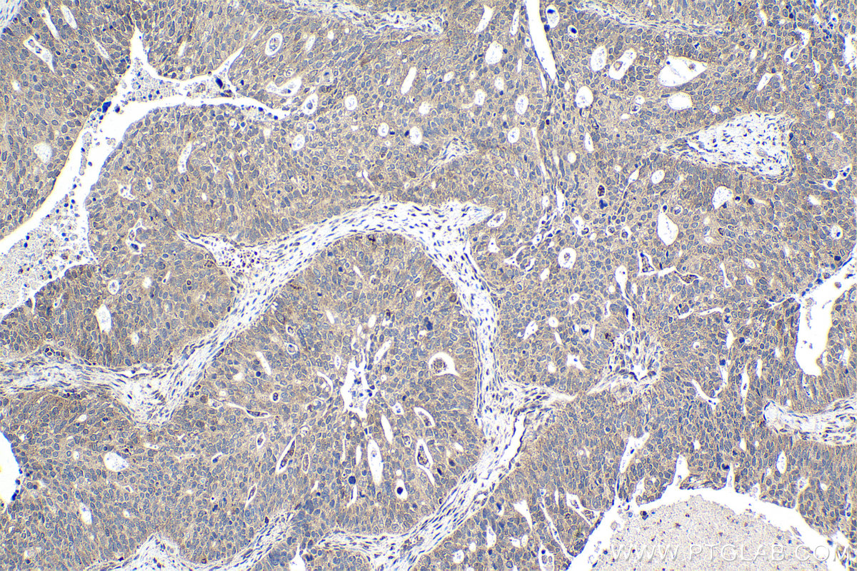 Immunohistochemistry (IHC) staining of human ovary tumor tissue using MSI2 Polyclonal antibody (10770-1-AP)