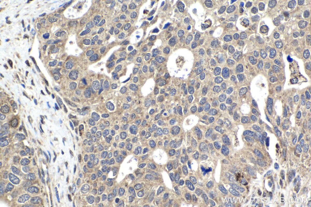 Immunohistochemistry (IHC) staining of human ovary tumor tissue using MSI2 Polyclonal antibody (10770-1-AP)