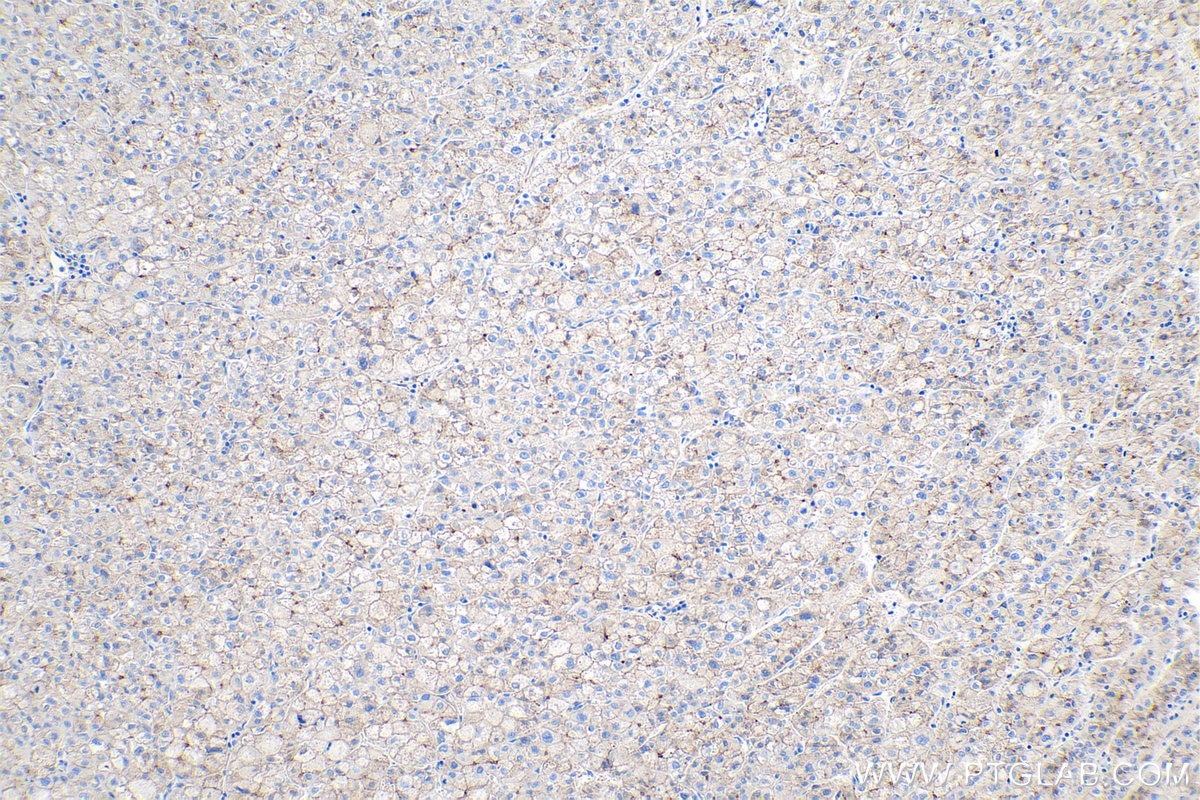 Immunohistochemistry (IHC) staining of human liver cancer tissue using N-cadherin Monoclonal antibody (66219-1-Ig)