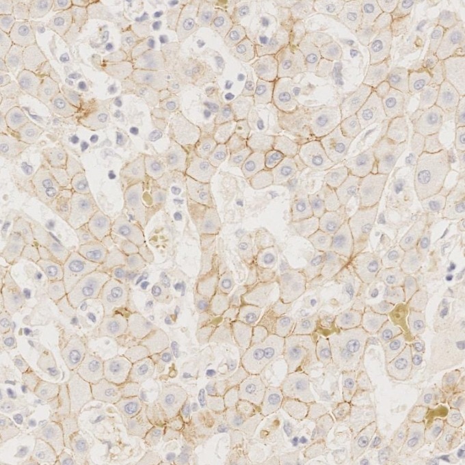 Immunohistochemistry (IHC) staining of Cholangiocarcinoma tissue using N-cadherin Monoclonal antibody (66219-1-Ig)