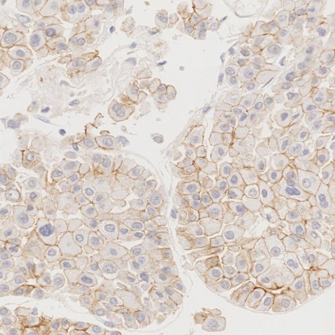 Immunohistochemistry (IHC) staining of human liver cancer tissue using N-cadherin Monoclonal antibody (66219-1-Ig)