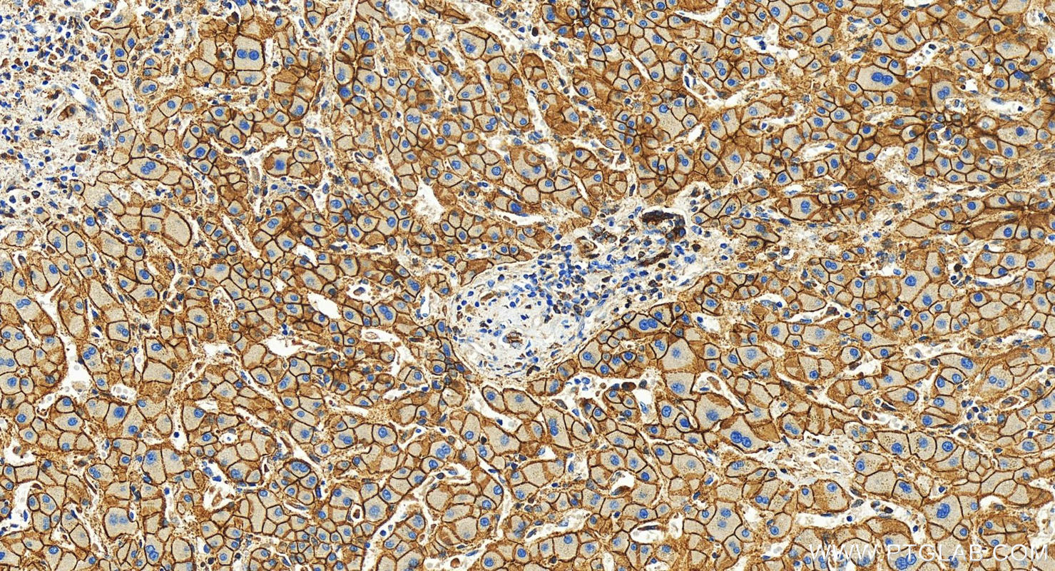 Immunohistochemistry (IHC) staining of human intrahepatic cholangiocarcinoma tissue using N-cadherin Recombinant antibody (82968-1-RR)