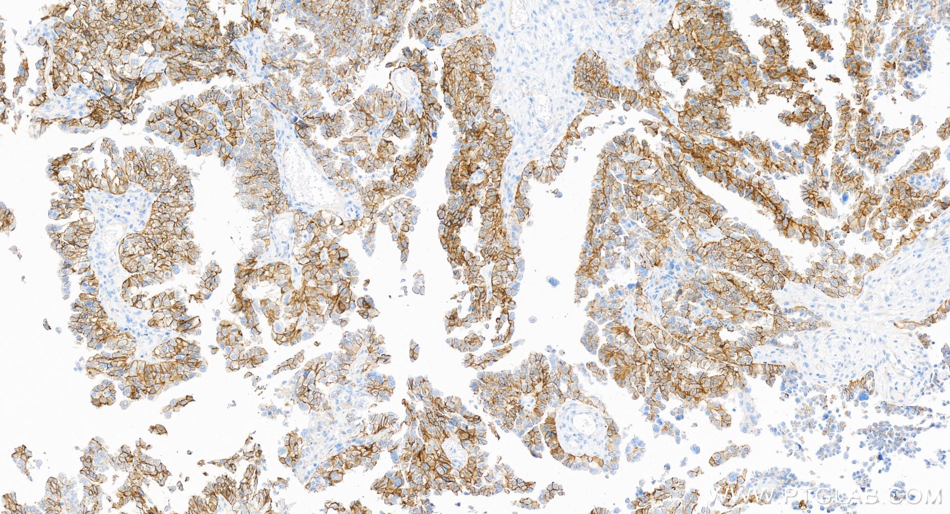 Immunohistochemistry (IHC) staining of human ovary cancer tissue using N-cadherin Recombinant antibody (82968-1-RR)