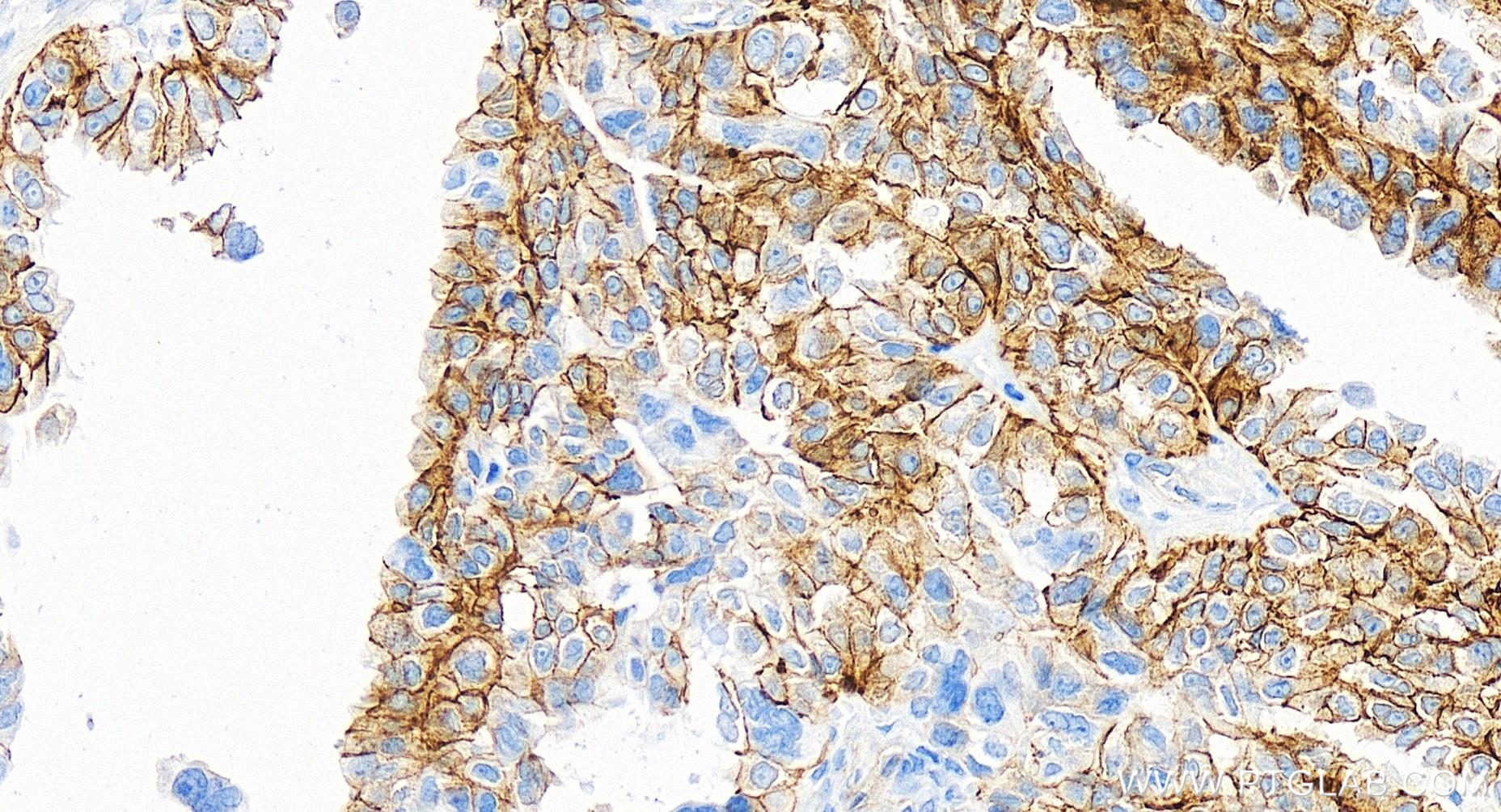 Immunohistochemistry (IHC) staining of human ovary cancer tissue using N-cadherin Recombinant antibody (82968-1-RR)