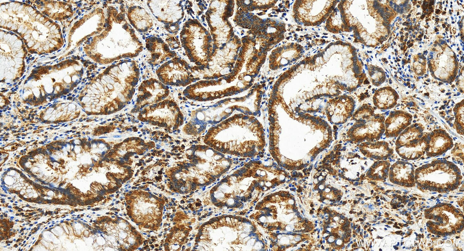 Immunohistochemistry (IHC) staining of human stomach cancer tissue using NADK Polyclonal antibody (29290-1-AP)