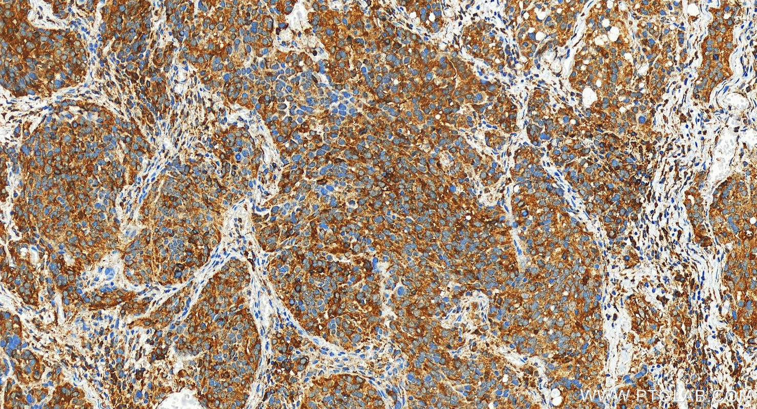 Immunohistochemistry (IHC) staining of human ovary cancer tissue using NADK Polyclonal antibody (29290-1-AP)