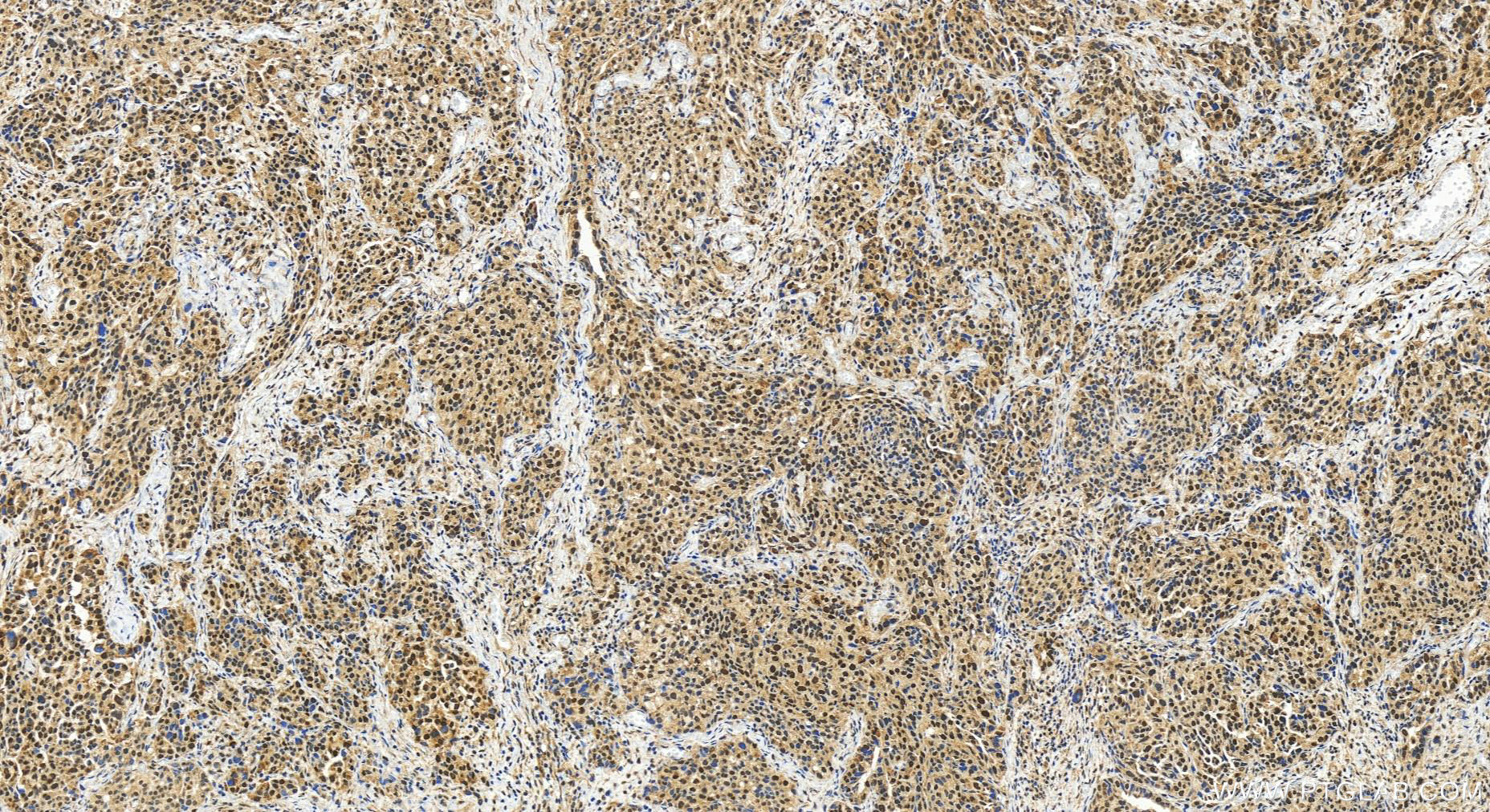 Immunohistochemistry (IHC) staining of human ovary cancer tissue using NAF1 Polyclonal antibody (27764-1-AP)