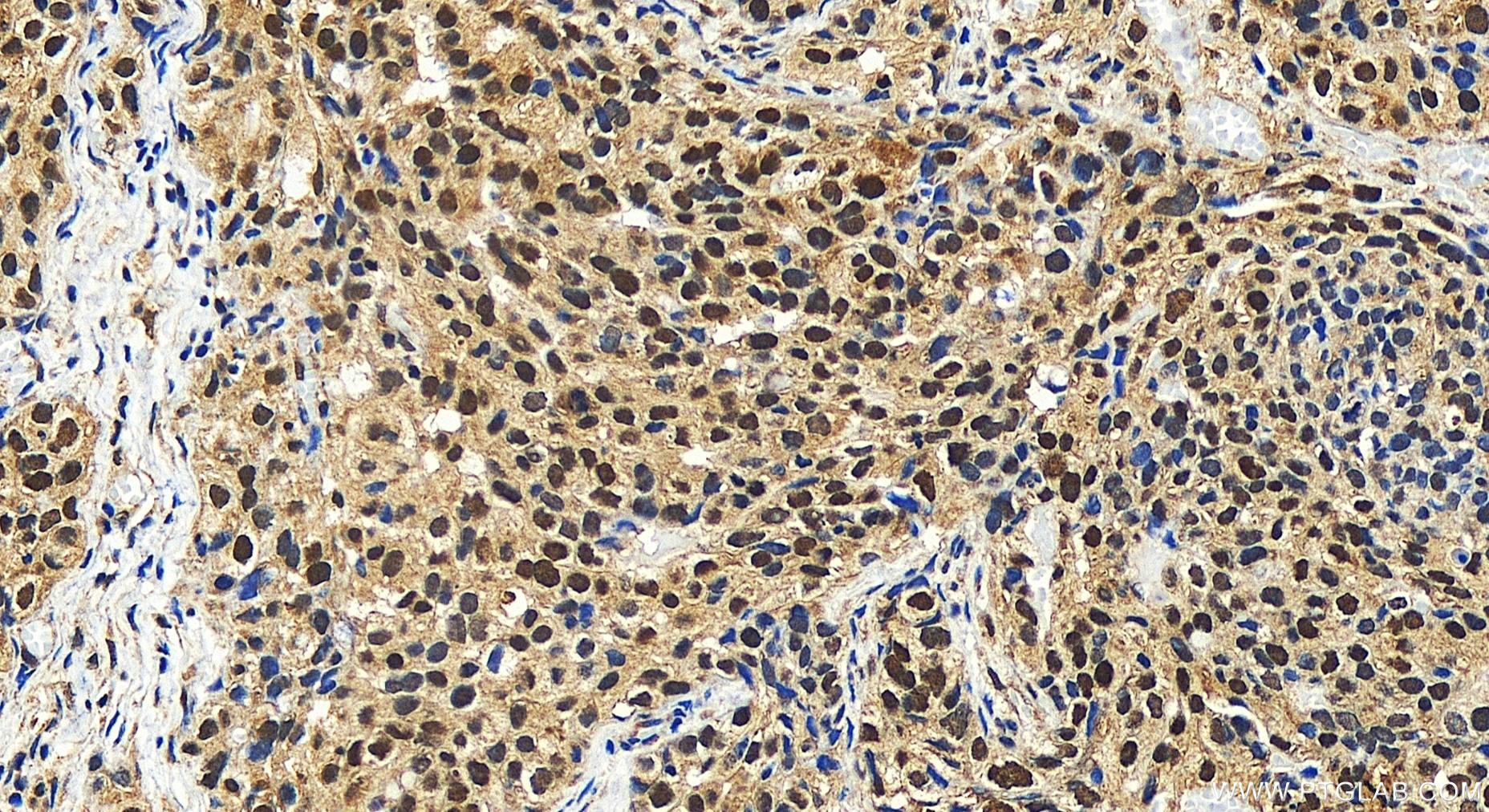 Immunohistochemistry (IHC) staining of human ovary cancer tissue using NAF1 Polyclonal antibody (27764-1-AP)