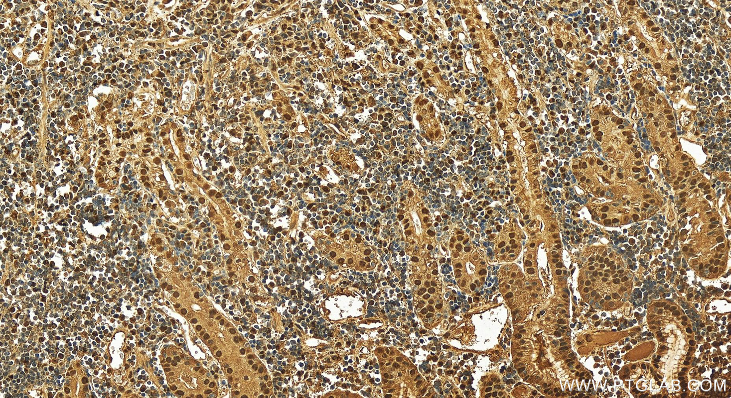 Immunohistochemistry (IHC) staining of human stomach cancer tissue using NANS Polyclonal antibody (15163-1-AP)