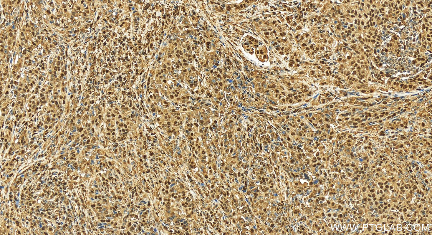 Immunohistochemistry (IHC) staining of human stomach cancer tissue using NANS Polyclonal antibody (15163-1-AP)