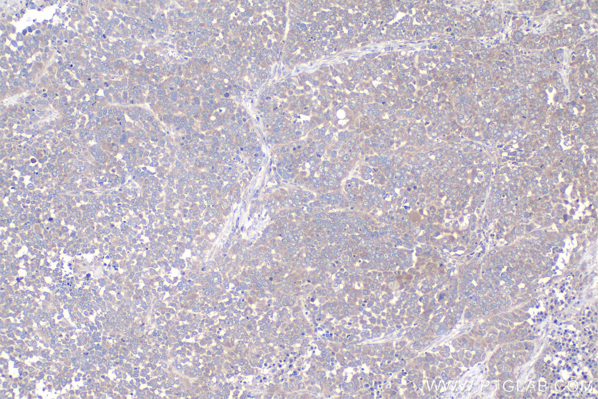 Immunohistochemistry (IHC) staining of human ovary tumor tissue using NAPG Polyclonal antibody (15604-1-AP)