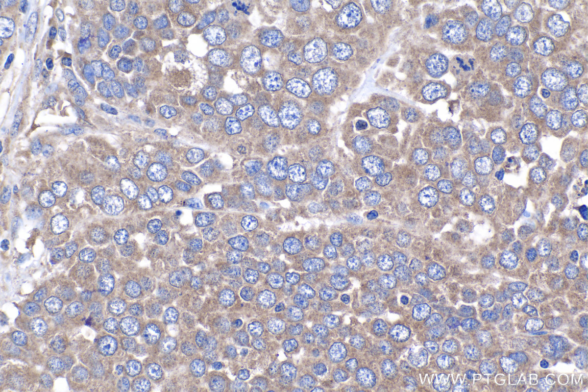 Immunohistochemistry (IHC) staining of human ovary tumor tissue using NAPG Polyclonal antibody (15604-1-AP)