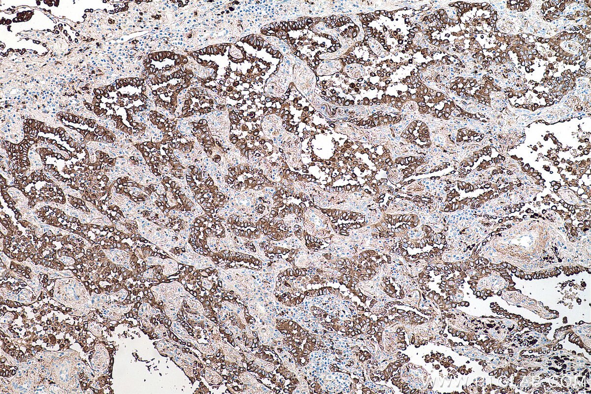 Immunohistochemistry (IHC) staining of human lung cancer tissue using Napsin A Monoclonal antibody (60259-2-Ig)