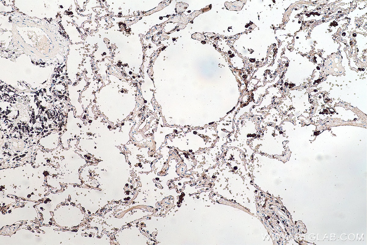 Immunohistochemistry (IHC) staining of human lung cancer tissue using Napsin A Monoclonal antibody (60259-2-Ig)