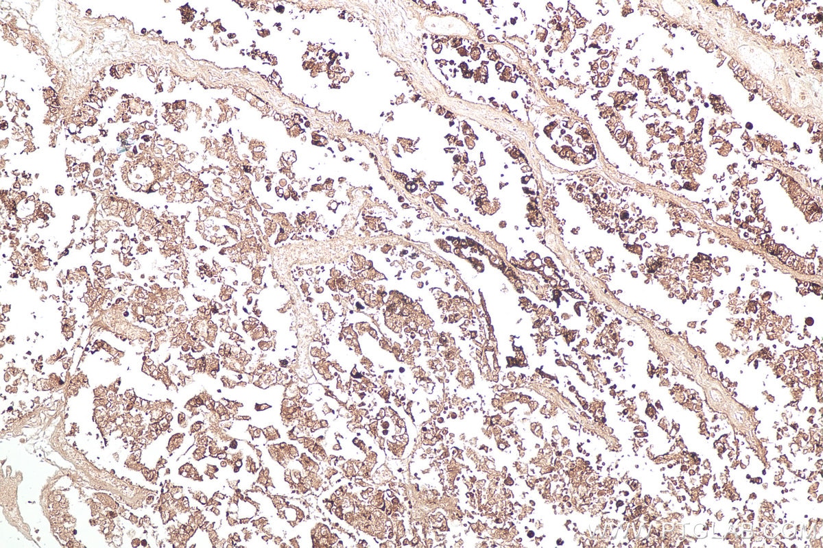 Immunohistochemistry (IHC) staining of human ovary tumor tissue using Napsin A Monoclonal antibody (60259-2-Ig)