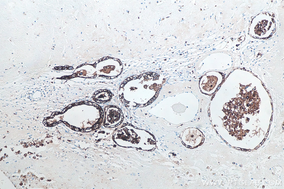 Immunohistochemistry (IHC) staining of human ovary tumor tissue using Napsin A Monoclonal antibody (60259-2-Ig)