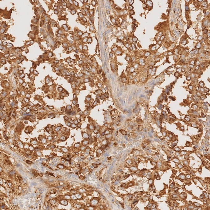Immunohistochemistry (IHC) staining of human lung cancer tissue using Napsin A Monoclonal antibody (60259-2-Ig)