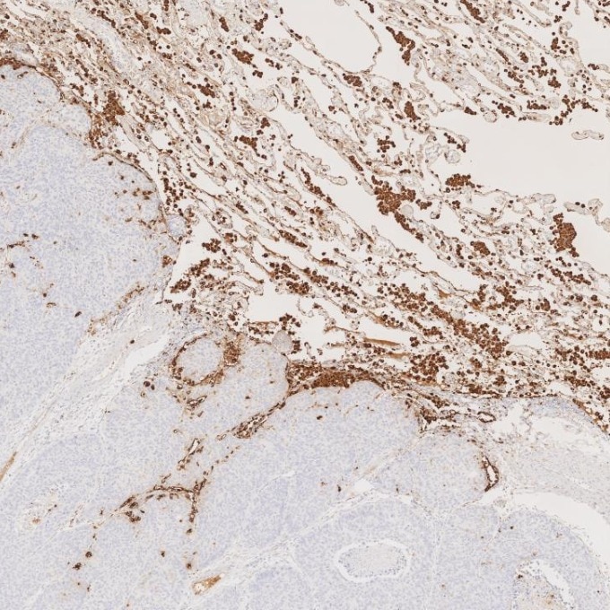 Immunohistochemistry (IHC) staining of human lung cancer tissue using Napsin A Monoclonal antibody (60259-2-Ig)