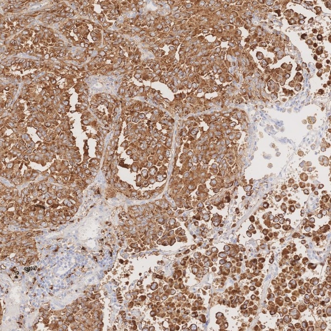 Immunohistochemistry (IHC) staining of human lung cancer tissue using Napsin A Monoclonal antibody (60259-2-Ig)