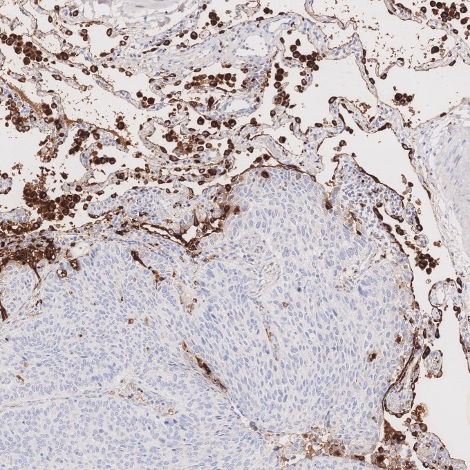 Immunohistochemistry (IHC) staining of human lung cancer tissue using Napsin A Monoclonal antibody (60259-2-Ig)