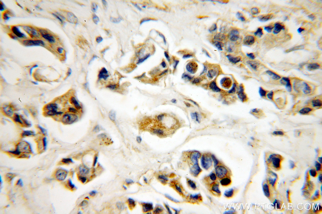 Immunohistochemistry (IHC) staining of human breast cancer tissue using NAT1 Polyclonal antibody (14394-1-AP)