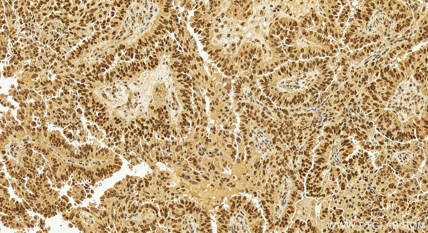 Immunohistochemistry (IHC) staining of human ovary cancer tissue using NAT10 Polyclonal antibody (13365-1-AP)