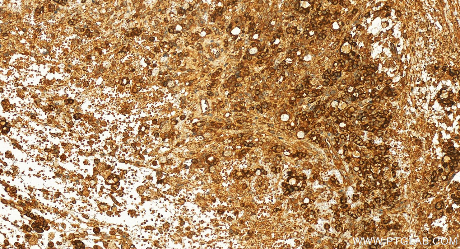 Immunohistochemistry (IHC) staining of human ovary cancer tissue using NAT13 Polyclonal antibody (16120-1-AP)