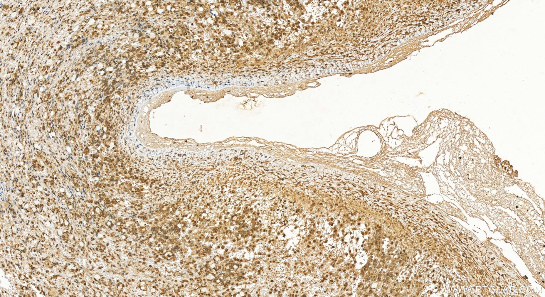 Immunohistochemistry (IHC) staining of human ovary cancer tissue using NAT5 Polyclonal antibody (15807-1-AP)