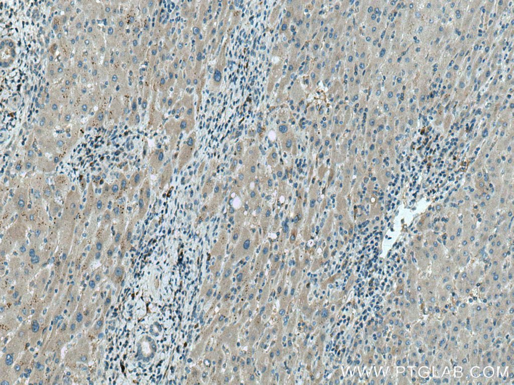 Immunohistochemistry (IHC) staining of human liver cancer tissue using NBCe2 Polyclonal antibody (26150-1-AP)