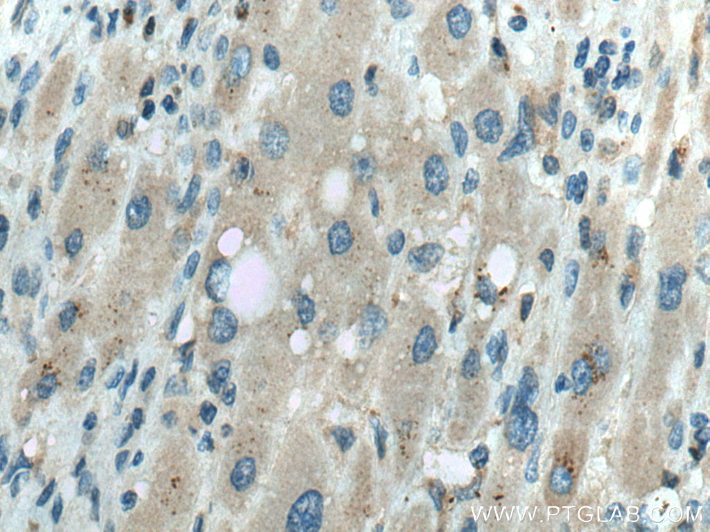 Immunohistochemistry (IHC) staining of human liver cancer tissue using NBCe2 Polyclonal antibody (26150-1-AP)