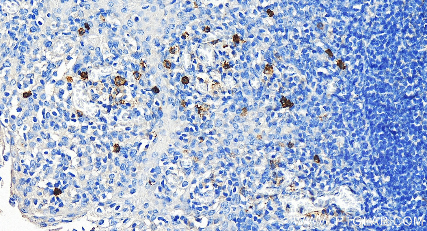 Immunohistochemistry (IHC) staining of human tonsillitis tissue using NCAM1/CD56 Polyclonal antibody (14255-1-AP)