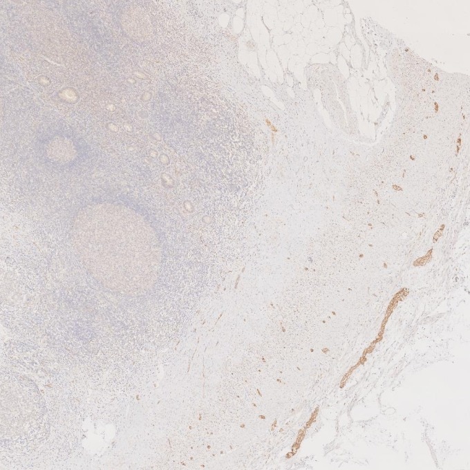 Immunohistochemistry (IHC) staining of human appendicitis tissue using NCAM1/CD56 Monoclonal antibody (60238-1-Ig)