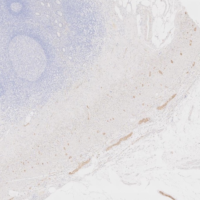 Immunohistochemistry (IHC) staining of human appendicitis tissue using NCAM1/CD56 Monoclonal antibody (60238-1-Ig)