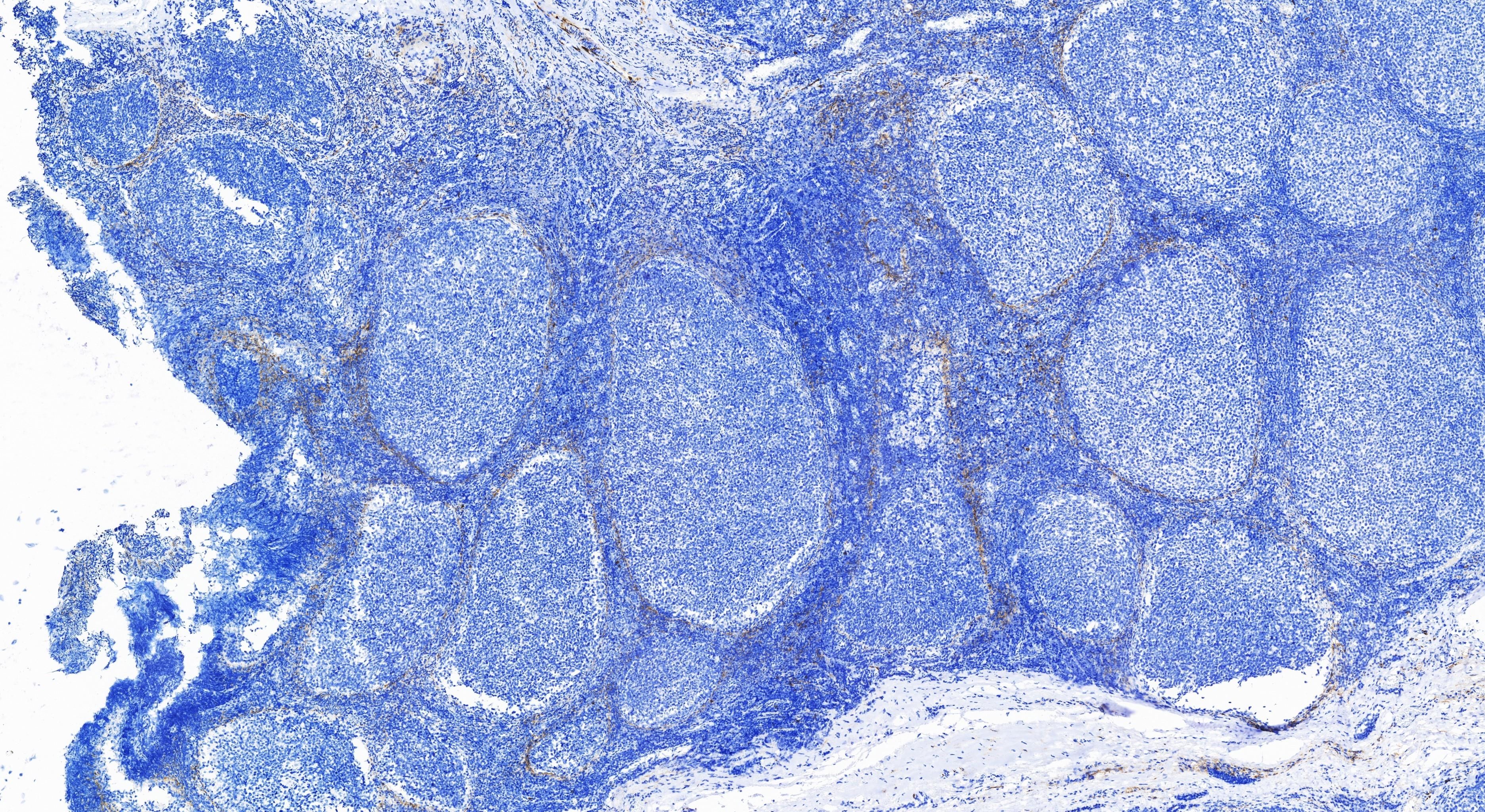 Immunohistochemistry (IHC) staining of human tonsillitis tissue using NCAM1/CD56 Recombinant antibody (82715-3-RR)