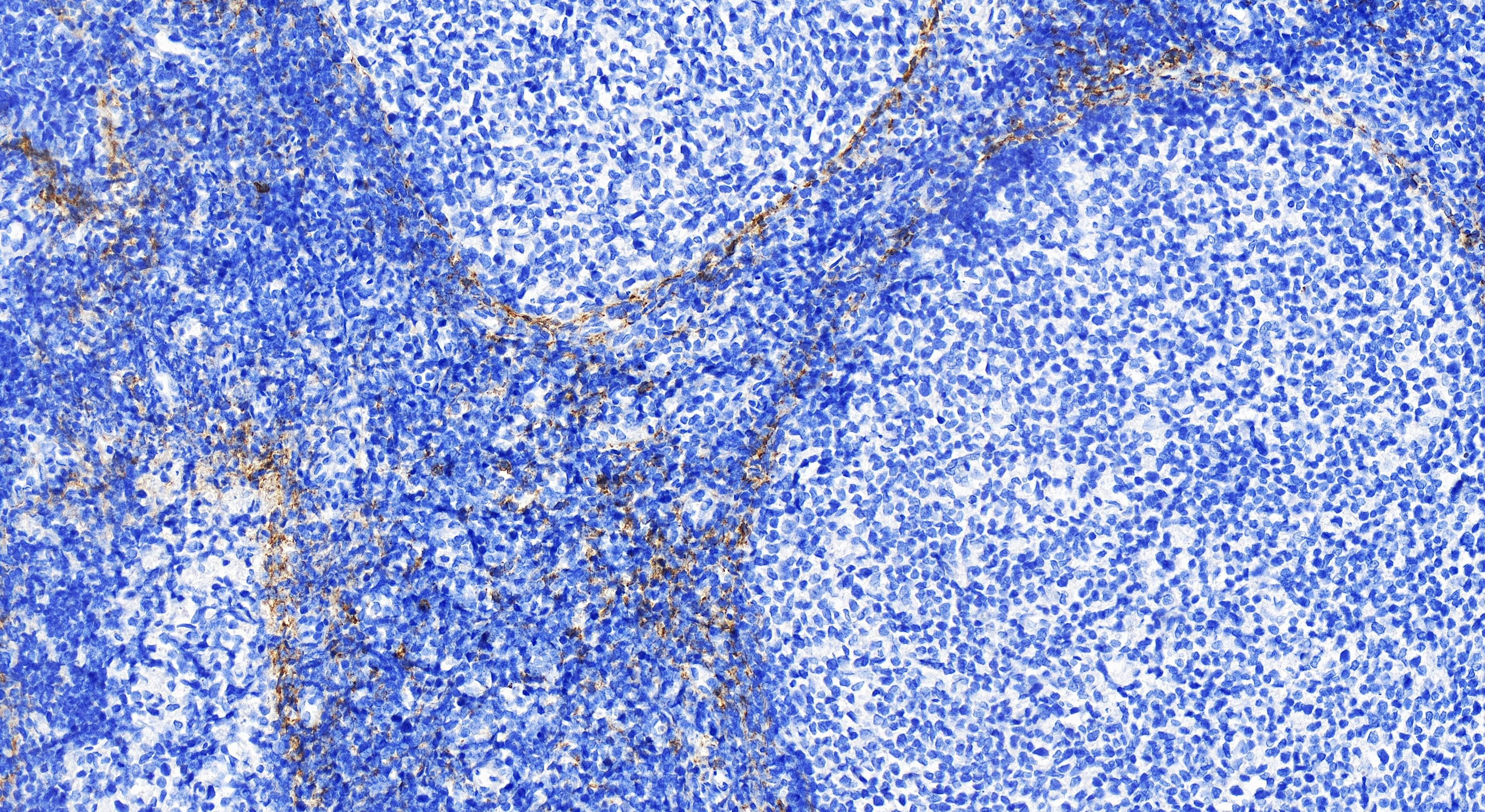 Immunohistochemistry (IHC) staining of human tonsillitis tissue using NCAM1/CD56 Recombinant antibody (82715-3-RR)