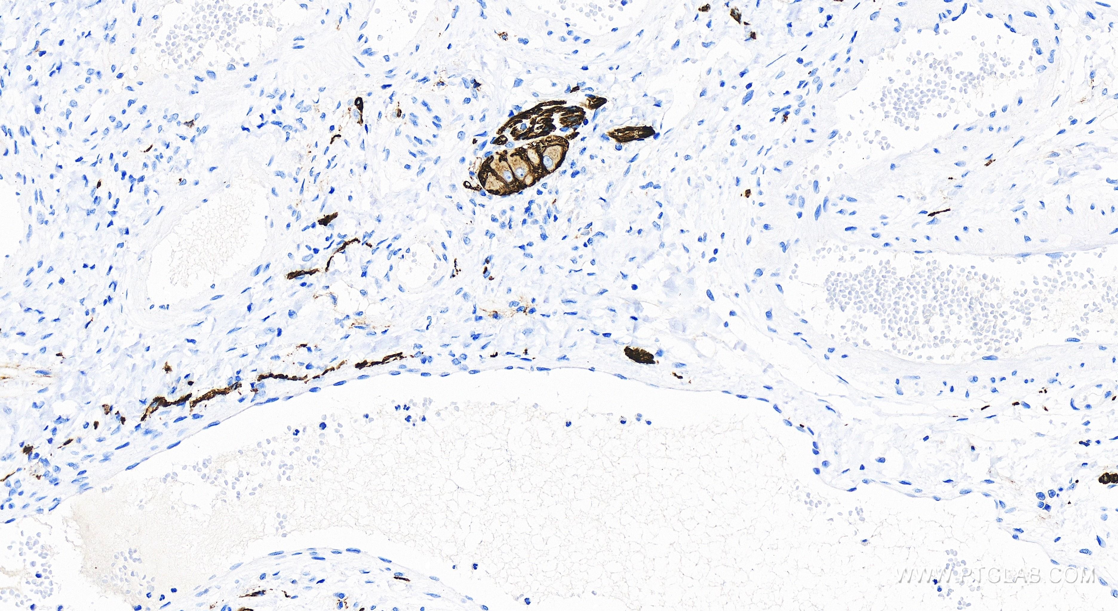 Immunohistochemistry (IHC) staining of human colon cancer tissue using NCAM1/CD56 Recombinant antibody (82715-3-RR)