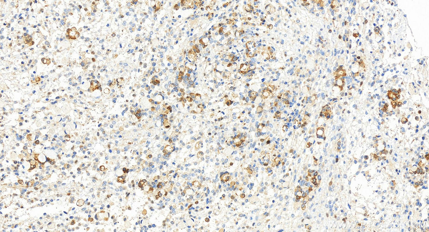 Immunohistochemistry (IHC) staining of human ovary cancer tissue using NCAPD2 Polyclonal antibody (13382-1-AP)