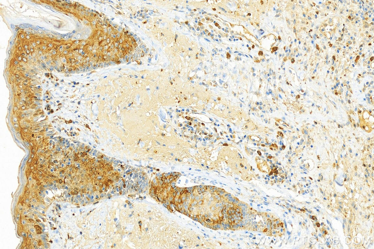 Immunohistochemistry (IHC) staining of human skin cancer tissue using NCAPD2 Polyclonal antibody (13382-1-AP)